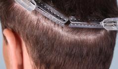 Before Hair Transplant&nbsp;Trichophytic Donor Scars